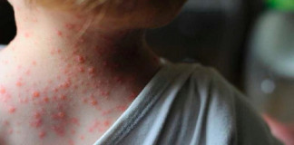 La viruela del Mono alerta al mundo por casos en EU y Europa