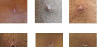 Confirma OMS detección de un caso de viruela de los Monos en Reino Unido