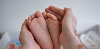 Afecta vitíligo en mayor medida a mujeres: IMSS Veracruz Sur