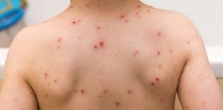 No confundir, La viruela del Mono no está vinculada con la vacuna anticovid