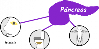 Conoce los síntomas del cáncer de páncreas .