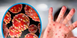 Veracruz y la viruela símica .