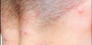 Veracruz confirmó su primer caso de viruela del Mono.