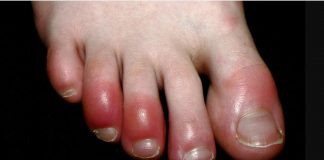 Dedos Covid y pies hinchados, síntoma del virus