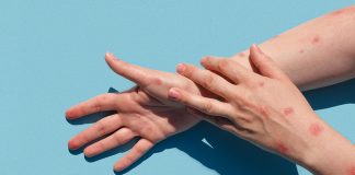 Sin evidencias de una nueva variante del virus de la Viruela del Mono.