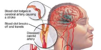 Cómo detectar un accidente cerebrovascular; consejos para el tratamiento y prevención