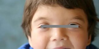 Conoce el síndrome Kabuki que afecta a infantes. (síntomas)