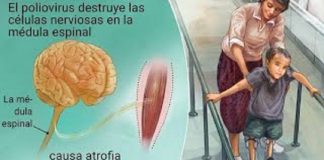 Poliomielitis amenaza con reaparecer en México
