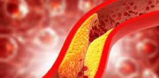 Consumir grasas saturadas en exceso aumenta el colesterol