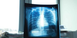 Hacen conciencia sobre riesgos de padecer EPOC .