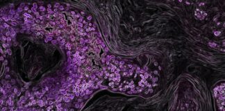 Presentan nuevo tratamiento contra cáncer de pulmón .