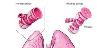 ASMA , un mal que puede controlarse