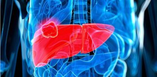 Consumo excesivo de azúcares, grasas y alcohol afecta funcionamiento del hígado: IMSS Veracruz Norte