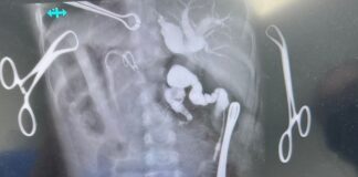 Reconstruye HGZ No. 71 del IMSS Veracruz Norte vía biliar de una niña de 3 años