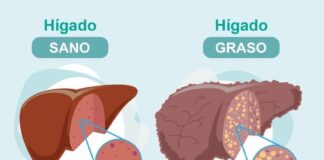 ¿Cuáles son los síntomas de la enfermedad del hígado graso no alcohólico?