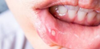 Explican las causas de la candidiasis oral .