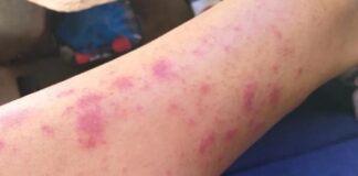 Alerta: Bacteria devoradora de carne fue identificada en playas de México.