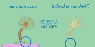 Atrofia Muscular Espinal. Todo lo que necesitas saber