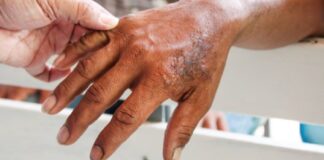 La Lepra es curable mediante tratamiento: IMSS Norte