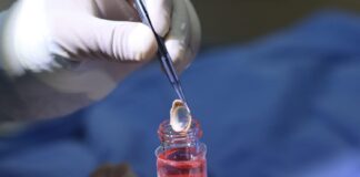 Logra IMSS Veracruz Sur tercera procuración de córneas .