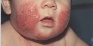 Informa IMSS Veracruz Norte sobre lupus .