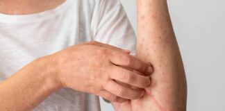 Informa IMSS Veracruz Norte sobre púrpura anafilactoide .