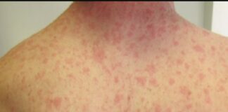 #Alerta epidemiológica en México por incremento de casos del Sarampión