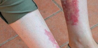 Llaman a identificar síntomas de vasculitis .