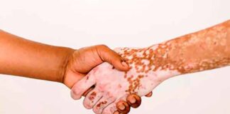 Entre 2 y 6 por ciento de los mexicanos padece vitiligo.