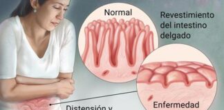¿Cuáles son los síntomas de la enfermedad celíaca o intolerancia al gluten?