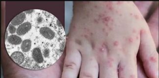 Estos son los estados en México con casos de Viruela del Mono.