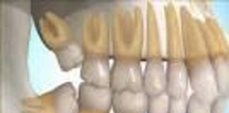 Desarrollan el primer fármaco para regenerar dientes perdidos.