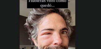 ¡Irreconocible! Osvaldo Benavides aparece con el rostro desfigurado: ¿qué le pasó?.