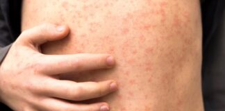 #Sarampión: Enfermedad viral que se contagia rápida y fácilmente.