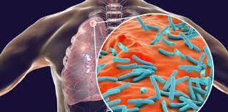 Veracruz lidera Estados con más casos de tuberculosis en México.