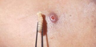 Detectan primer caso humano de miasis por gusano barrenador en Chiapas.