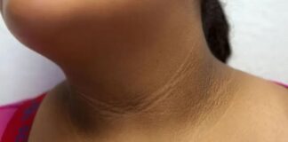 Advierte IMSS Veracruz Norte síntomas de resistencia a la insulina