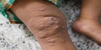 Conoce los síntomas del virus monkeypox para evitar complicaciones.