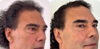 Así es el tratamiento estético que rejuveneció el rostro de Eduardo Yáñez.