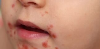 En escuelas de Xico, Coatepec y Teocelo reportan brotes del virus Coxsackie.