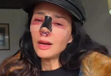 La modelo Dorismar enfrenta graves secuelas por una cirugía estética