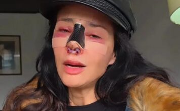 La modelo Dorismar enfrenta graves secuelas por una cirugía estética