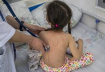 Niñas de 0 a 4 años las más afectadas por repunte de sarampión en México