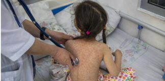 Niñas de 0 a 4 años las más afectadas por repunte de sarampión en México