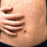 Rocío Nahle refuerza la campaña de vacunación ante el brote de sarampión con 13 casos confirmados