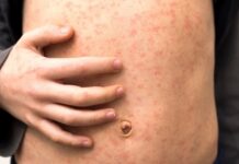 Rocío Nahle refuerza la campaña de vacunación ante el brote de sarampión con 13 casos confirmados