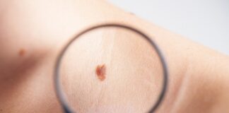 Advierte IMSS Veracruz Norte respecto a la aparición de melanoma.