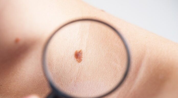 Advierte IMSS Veracruz Norte respecto a la aparición de melanoma.